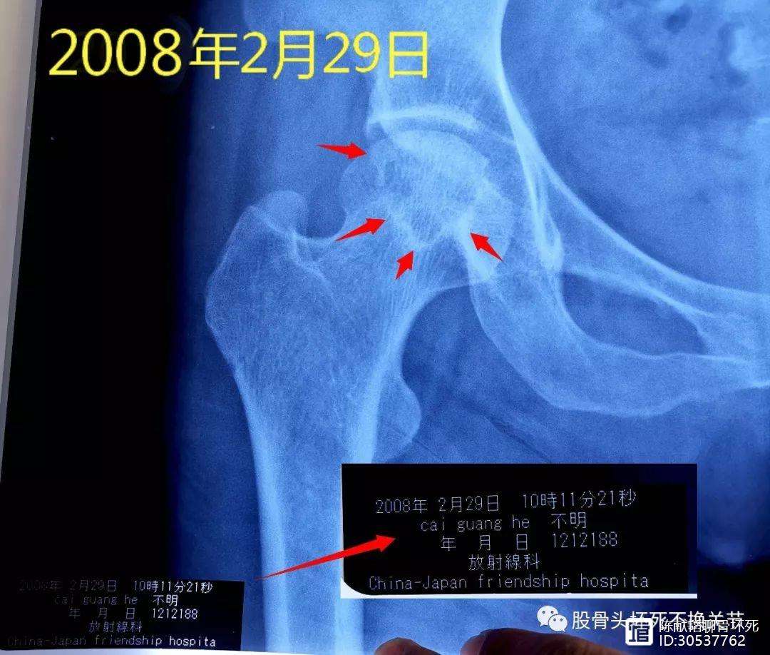 茂名人工骨头医保报销多少(人工骨头医保报销多少比例)